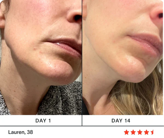 The 4-in-1 Radiant Renewal Wand (Red Light Therapy)